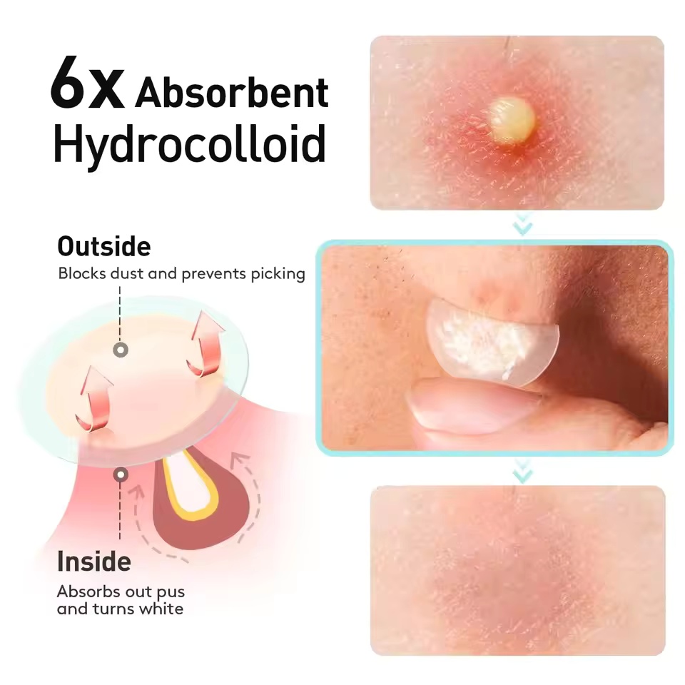 360 pieces/box acne patches -  - Essential Oils 评论和价格